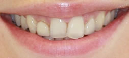 Before veneers