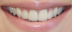 After Veneers