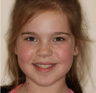 After Cosmetic Dentistry