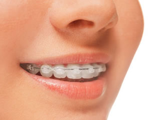Clear Damon braces