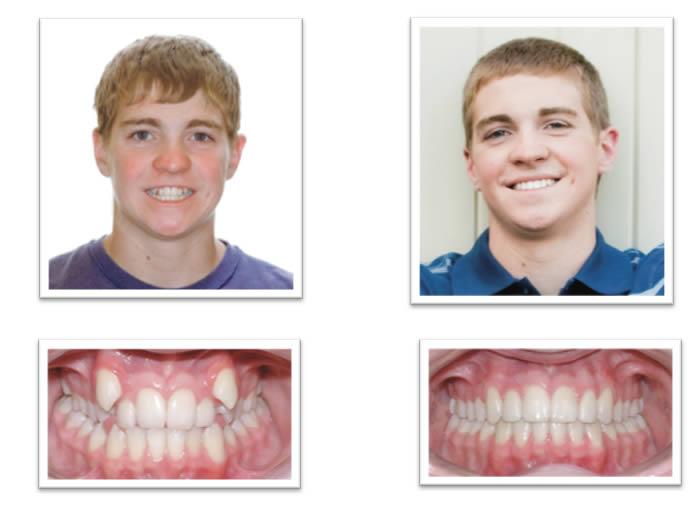 Damon braces case 2 in Birmingham