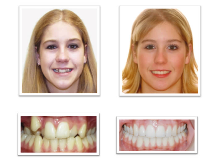 Damon braces case 3 in Birmingham