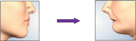  Premature  ageing
