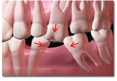 Damage  to remaining teeth