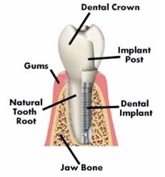 Dental implant placement