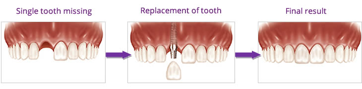 single missing  tooth
