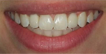 After dental implants