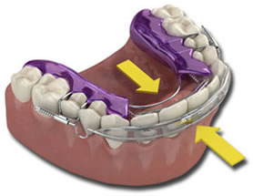 Inman Aligner