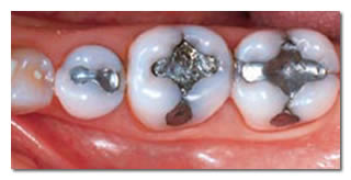 Mercury Free Dentistry