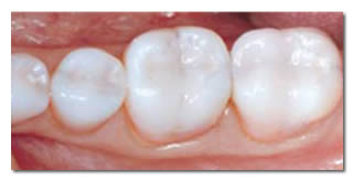 Mercury Free White Fillings