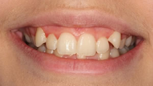 Hannah Before