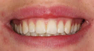 After orthodontic  treatment