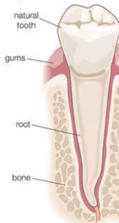 Root canal