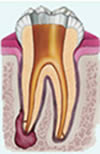 Root canals cleaned