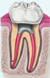 New crown placed on the root